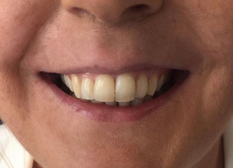 Orthodontic Treatment for Deep Overbite